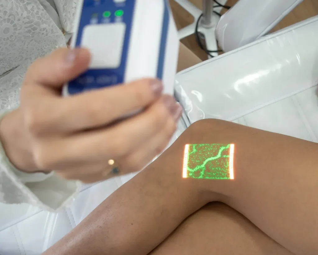 laser transdermico varize